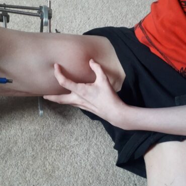 94 Patients Were Harmed By Great Ormond Street Surgeon Review Finds